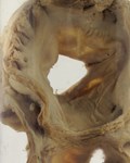 Heart with stenosis